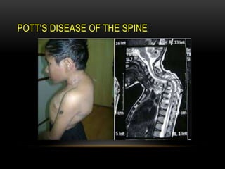 POTT’S DISEASE OF THE SPINE
 