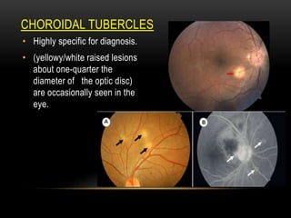TUBERCLES
CHOROIDAL
• Highly specific for diagnosis.
• (yellowy/white raised lesions
about one-quarter the
diameter of the optic disc)
are occasionally seen in the
eye.
 