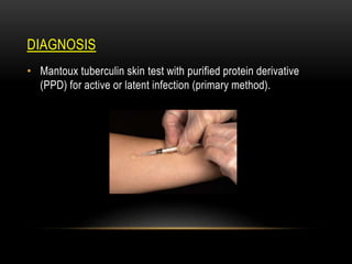 DIAGNOSIS
• Mantoux tuberculin skin test with purified protein derivative
(PPD) for active or latent infection (primary method).
 