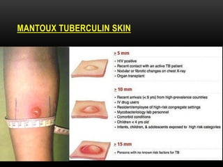 TUBERCULIN SKIN
MANTOUX
 
