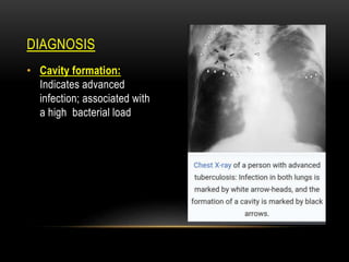 DIAGNOSIS
• Cavity formation:
Indicates advanced
infection; associated with
a high bacterial load
 