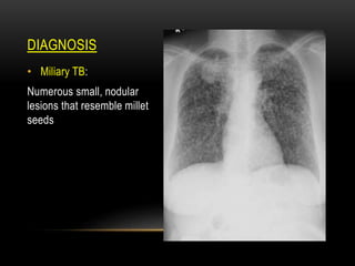 DIAGNOSIS
• Miliary TB:
Numerous small, nodular
lesions that resemble millet
seeds
 