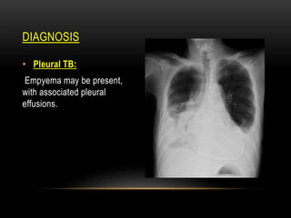 DIAGNOSIS
• Pleural TB:
Empyema may be present,
with associated pleural
effusions.
 