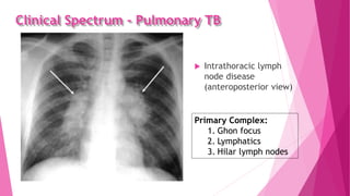 Clinical Spectrum - Pulmonary TB
 Intrathoracic lymph
node disease
(anteroposterior view)
Primary Complex:
1. Ghon focus
2. Lymphatics
3. Hilar lymph nodes
 