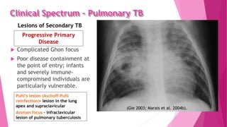Clinical Spectrum – Pulmonary TB
 Complicated Ghon focus
 Poor disease containment at
the point of entry; infants
and severely immune-
compromised individuals are
particularly vulnerable.
(Gie 2003; Marais et al. 2004b).
Lesions of Secondary TB
Puhl’s lesion (Aschoff-Puhl
reinfection)– lesion in the lung
apex and supraclavicular
Assman focus – Infraclavicular
lesion of pulmonary tuberculosis
Progressive Primary
Disease
 