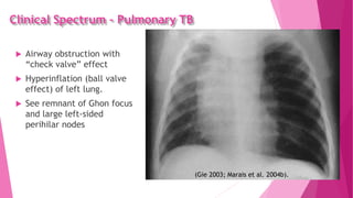 Clinical Spectrum – Pulmonary TB
 Airway obstruction with
“check valve” effect
 Hyperinflation (ball valve
effect) of left lung.
 See remnant of Ghon focus
and large left-sided
perihilar nodes
(Gie 2003; Marais et al. 2004b).
 