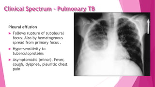 Clinical Spectrum – Pulmonary TB
Pleural effusion
 Follows rupture of subpleural
focus. Also by hematogenous
spread from primary focus .
 Hypersensitivity to
tuberculoproteins
 Asymptomatic (minor), Fever,
cough, dyspnea, pleuritic chest
pain
 