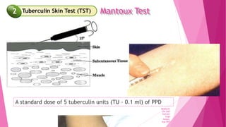 PEDISATC
ON 2007
Varinder
Singh
Hassan,
Aug 2007
Mantoux Test
A standard dose of 5 tuberculin units (TU - 0.1 ml) of PPD
Tuberculin Skin Test (TST)
2
 