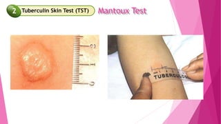 Mantoux Test
Tuberculin Skin Test (TST)
2
 