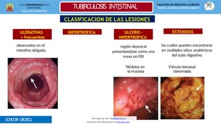 UNIVERSIDAD
NACIONAL
“SAN LUIS GONZAGA”
FACULTAD DE MEDICINA HUMANA
“DANIEL ALCIDES CARRÌON GARCÌA”
TUB[RCULOSIS INT[STINAL
CONDORI OROSCO
,
CLASIFICACION DE LAS LESIONES
ULERATIVAS
+ frecuentes
HIPERTROFICA ULCERO -
HIPERTROFICA
ESTENOSIS
observadas en el
intestino delgado.
regi6n ileocecal
presentandose como una
masa en FID
las cuales pueden encontrarse
en multiples sitios anat6micos
del tubo digestivo
Descargado por Kevin (kavs64@hotmail.com)
Encuentra más documentos en www.udocz.com
 
