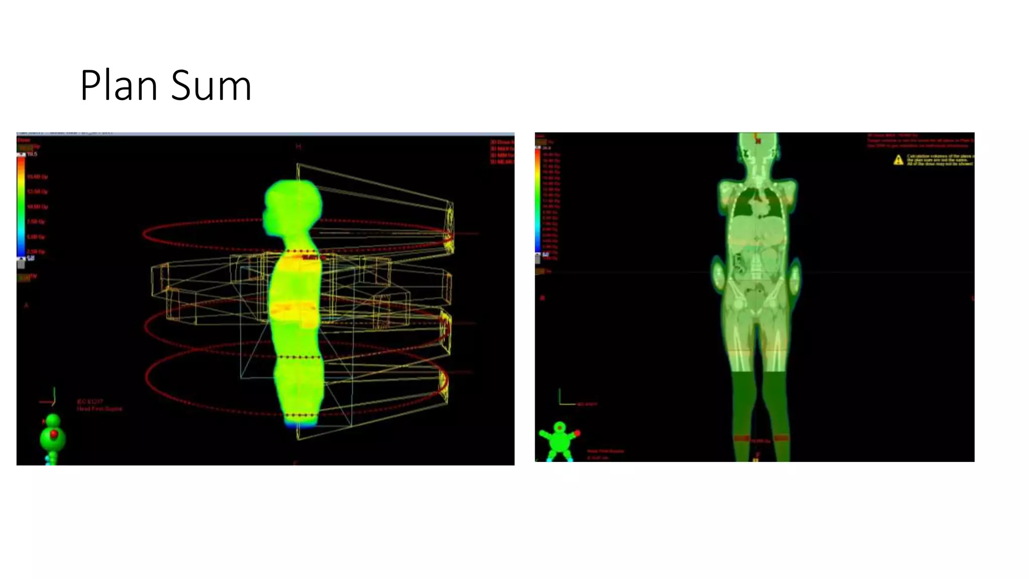 Total body irradiation tbi planning pptx