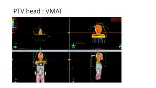 Tbi Radiotherapy Total Body Irradiation (TBI) Planning | PPTX