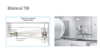 Tbi Radiotherapy Total Body Irradiation (TBI) Planning | PPTX