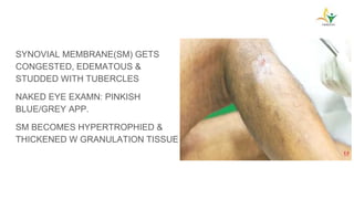 SYNOVIAL MEMBRANE(SM) GETS
CONGESTED, EDEMATOUS &
STUDDED WITH TUBERCLES
NAKED EYE EXAMN: PINKISH
BLUE/GREY APP.
SM BECOMES HYPERTROPHIED &
THICKENED W GRANULATION TISSUE
 