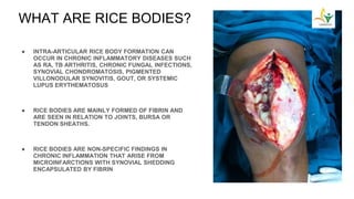 ● INTRA-ARTICULAR RICE BODY FORMATION CAN
OCCUR IN CHRONIC INFLAMMATORY DISEASES SUCH
AS RA, TB ARTHRITIS, CHRONIC FUNGAL INFECTIONS,
SYNOVIAL CHONDROMATOSIS, PIGMENTED
VILLONODULAR SYNOVITIS, GOUT, OR SYSTEMIC
LUPUS ERYTHEMATOSUS
● RICE BODIES ARE MAINLY FORMED OF FIBRIN AND
ARE SEEN IN RELATION TO JOINTS, BURSA OR
TENDON SHEATHS.
● RICE BODIES ARE NON-SPECIFIC FINDINGS IN
CHRONIC INFLAMMATION THAT ARISE FROM
MICROINFARCTIONS WITH SYNOVIAL SHEDDING
ENCAPSULATED BY FIBRIN
WHAT ARE RICE BODIES?
 