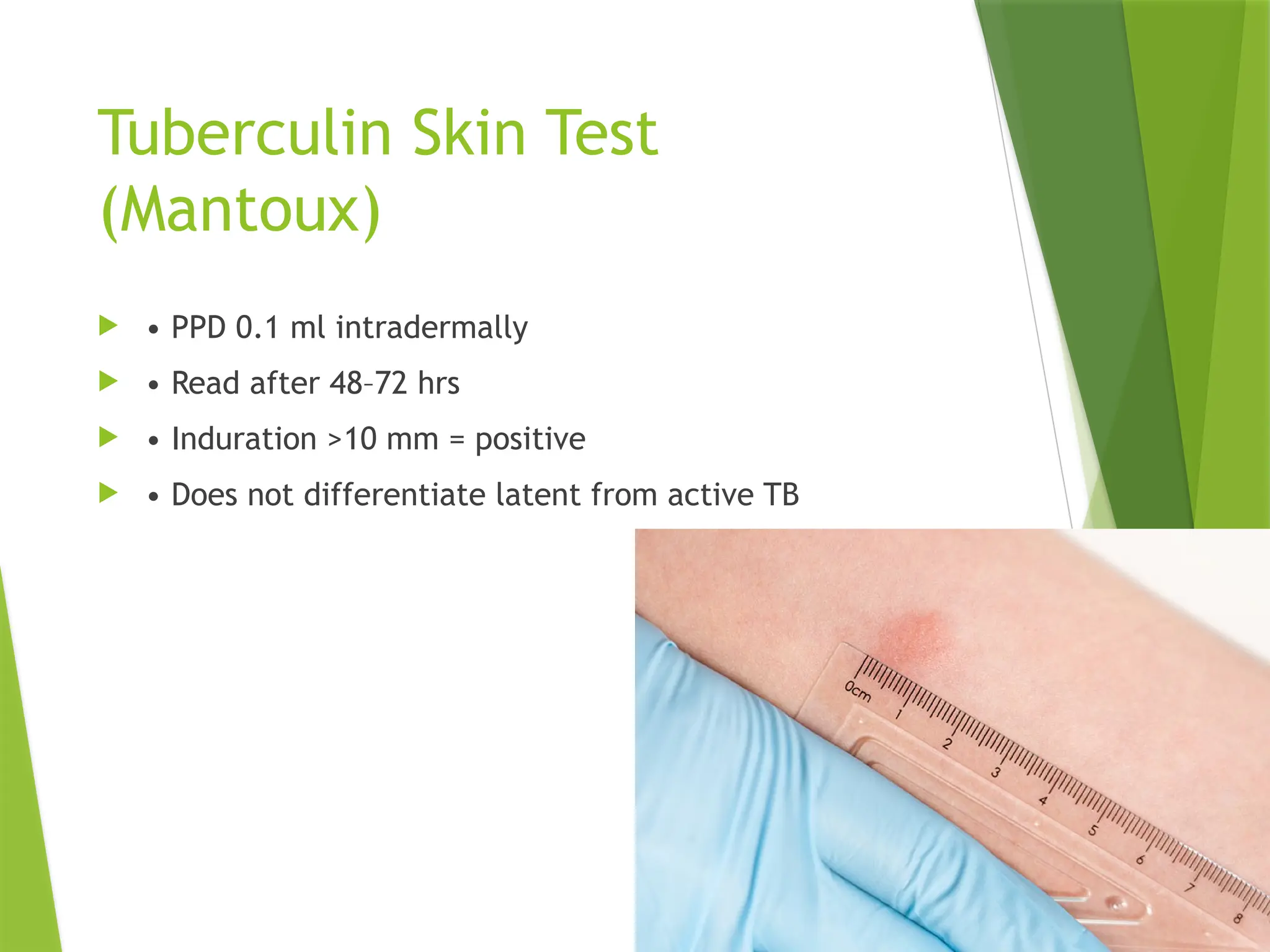 Tuberculin Skin Test
(Mantoux)
 • PPD 0.1 ml intradermally
 • Read after 48–72 hrs
 • Induration >10 mm = positive
 • Does not differentiate latent from active TB
 