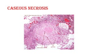 Comprehensive Pathology of Tubercular Lymphadenitis: Histology and ...