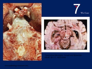 7We Care
neuropathology.neoucom.edu
Tuberculous Meningitis. Donald and Shoerman,
NEJM. 351:17. 10/21/2004
 