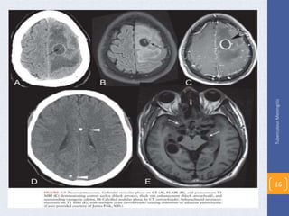 TuberculousMeningitis
16
 