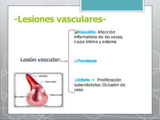 -Lesiones vasculares-
Lesión vascular:
Vasculitis: Afección
inflamatoria de los vasos;
capa intima y externa
Trombosis
...