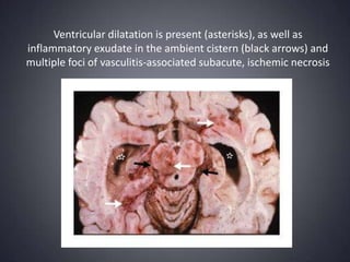 Ventricular dilatation is present (asterisks), as well as inflammatory exudate in the ambient cistern (black arrows) and multiple foci of vasculitis-associated subacute, ischemic necrosis
