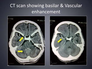CT scan showing basilar & Vascular enhancement