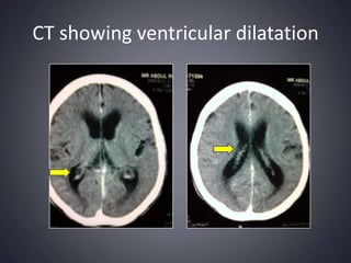 CT showing ventricular dilatation