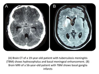Tb meningitis | PPTX