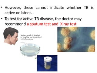 • However, these cannot indicate whether TB is
active or latent.
• To test for active TB disease, the doctor may
recommend a sputum test and X ray test
 
