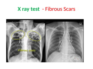 X ray test - Fibrous Scars
 