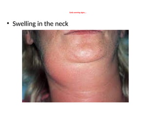 Early warning signs….
• Swelling in the neck
 