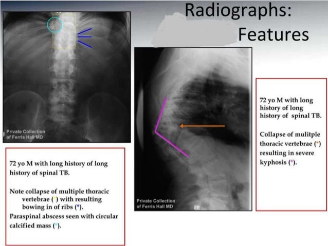 Tubeculosis of spine chhabi final ortho presentation