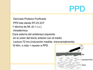 TUBERCULOSIS PULMONOR | PPTX