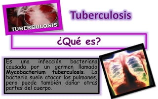 ¿Qué es?
Es una infección bacteriana
causada por un germen llamado
Mycobacterium tuberculosis. La
bacteria suele atacar los pulmones,
pero puede también dañar otras
partes del cuerpo.
 