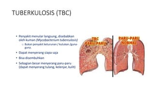 • Penyakit menular langsung, disebabkan
oleh kuman (Mycobacterium tuberculosis)
o Bukan penyakit keturunan / kutukan /guna-
guna.
• Dapat menyerang siapa saja
• Bisa disembuhkan
• Sebagian besar menyerang paru-paru
(dapat menyerang tulang, kelenjar, kulit)
TUBERKULOSIS (TBC)
 