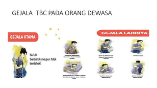 GEJALA TBC PADA ORANG DEWASA
 