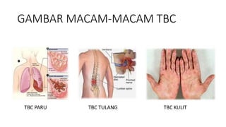 GAMBAR MACAM-MACAM TBC
TBC PARU TBC TULANG TBC KULIT
 