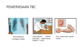 PEMERIKSAAN TBC
 