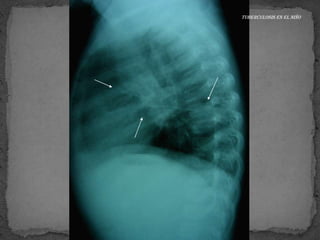 Tuberculosis en el niño
 