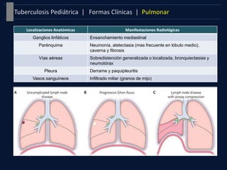 Formas Clínicas | PulmonarTuberculosis Pediátrica |
Localizaciones Anatómicas Manifestaciones Radiológicas
Ganglios linfáticos Ensanchamiento mediastinal
Parénquima Neumonía, atelectasia (mas frecuente en lóbulo medio),
caverna y fibrosis
Vías aéreas Sobredistención generalizada o localizada, bronquiectasias y
neumotórax
Pleura Derrame y paquipleuritis
Vasos sanguíneos Infiltrado miliar (granos de mijo)
 