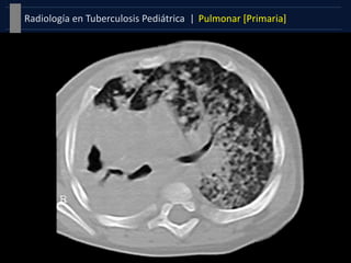 Pulmonar [Primaria]Radiología en Tuberculosis Pediátrica |
 