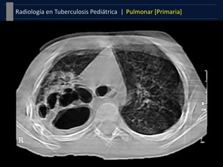 Pulmonar [Primaria]Radiología en Tuberculosis Pediátrica |
 