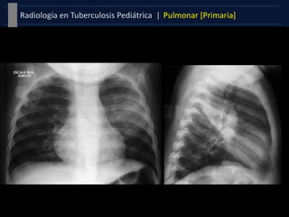 Pulmonar [Primaria]Radiología en Tuberculosis Pediátrica |
 
