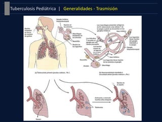 Generalidades - TrasmisiónTuberculosis Pediátrica |
 
