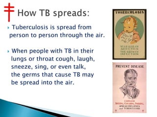  Tuberculosis is spread from
person to person through the air.
 When people with TB in their
lungs or throat cough, laugh,
sneeze, sing, or even talk,
the germs that cause TB may
be spread into the air.
 