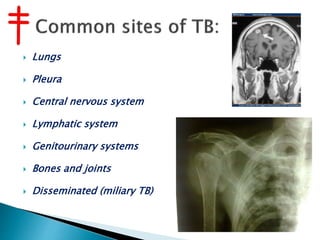  Lungs
 Pleura
 Central nervous system
 Lymphatic system
 Genitourinary systems
 Bones and joints
 Disseminated (miliary TB)
 