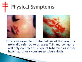 This is an example of tuberculosis of the skin it is
normally referred to as Warty T.B. and someone
will only contract this type of tuberculosis if they
have had prior exposure to tuberculosis.
 