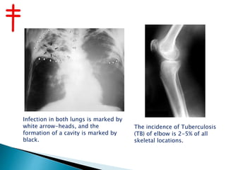 Infection in both lungs is marked by
white arrow-heads, and the
formation of a cavity is marked by
black.
The incidence of Tuberculosis
(TB) of elbow is 2-5% of all
skeletal locations.
 
