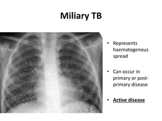Miliary TB
• Represents
haematogenous
spread
• Can occur in
primary or post-
primary disease
• Active disease
 