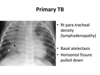 Primary TB
• Rt para-tracheal
density
(lymphadenopathy)
• Basal atelectasis
• Horizontal fissure
pulled down
 